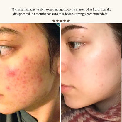 Nuderma High Frequency Therapy | Clear Acne and Prevent Future Breakouts