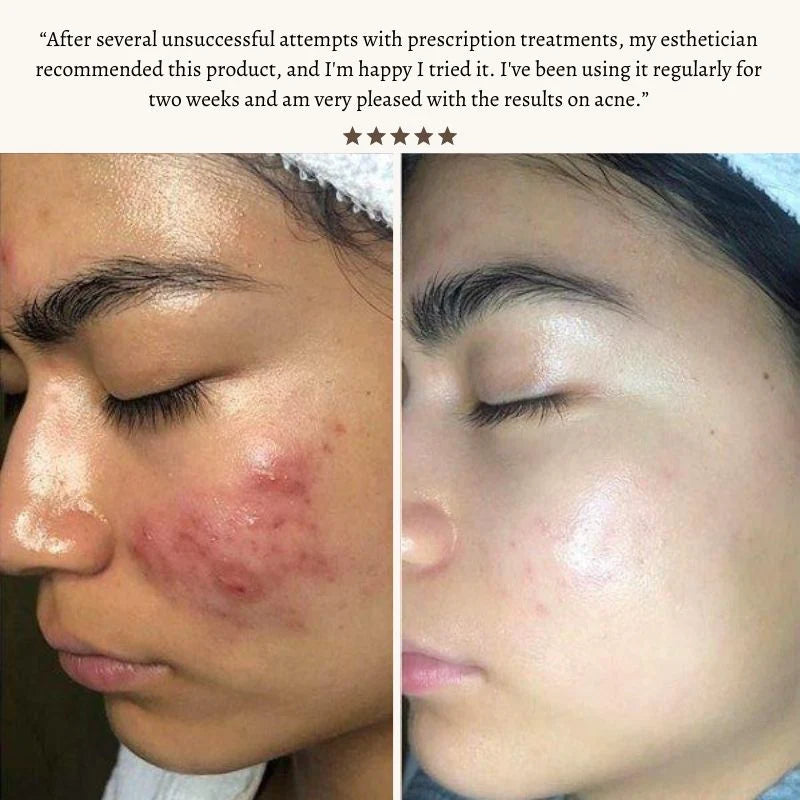 Nuderma High Frequency Therapy | Clear Acne and Prevent Future Breakouts
