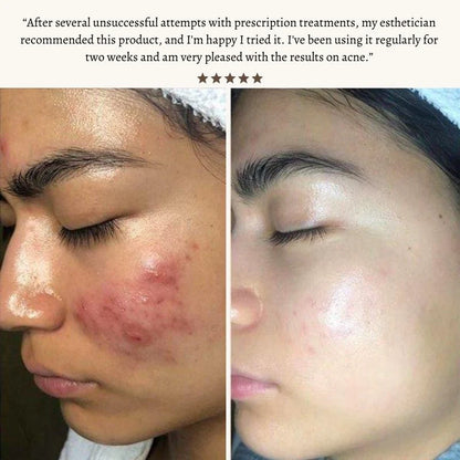 Nuderma High Frequency Therapy | Clear Acne and Prevent Future Breakouts