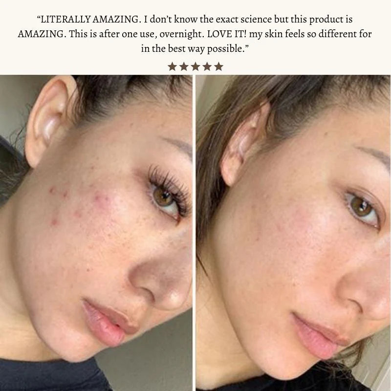 Nuderma High Frequency Therapy | Clear Acne and Prevent Future Breakouts