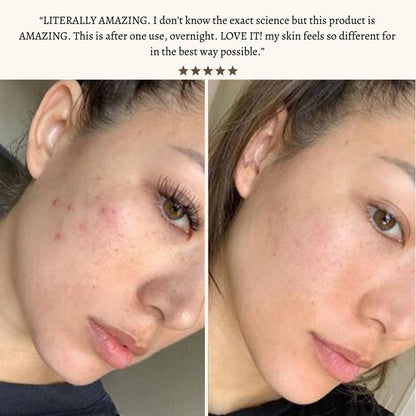 Nuderma High Frequency Therapy | Clear Acne and Prevent Future Breakouts