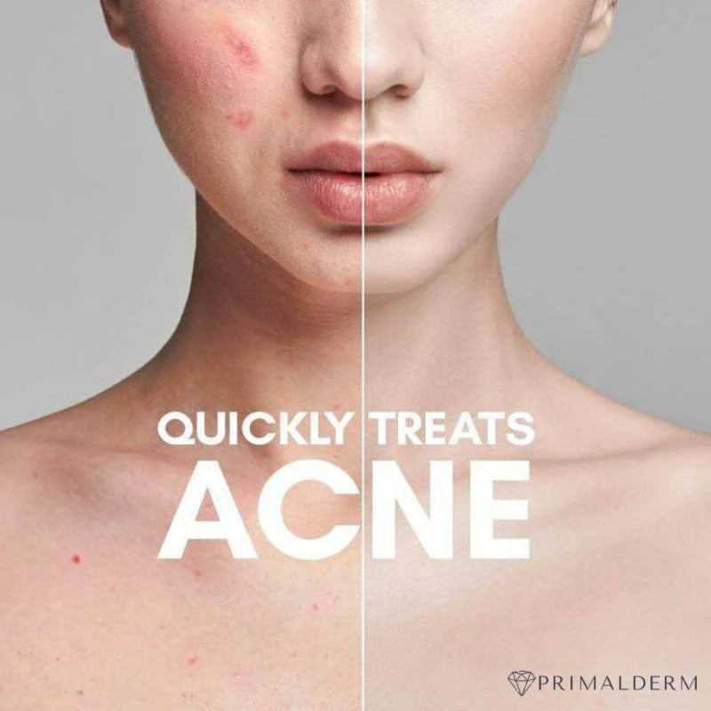 Nuderma High Frequency Therapy | Clear Acne and Prevent Future Breakouts
