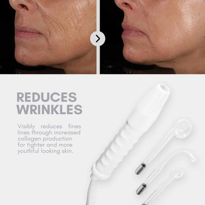 Nuderma High Frequency Therapy | Clear Acne and Prevent Future Breakouts