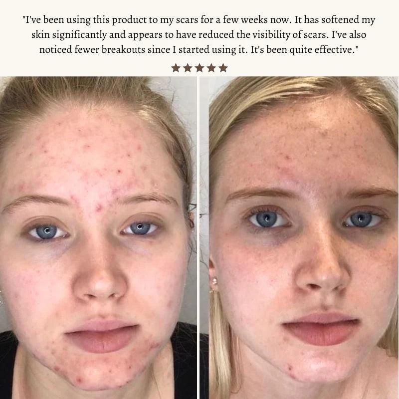 Nuderma High Frequency Therapy | Clear Acne and Prevent Future Breakouts